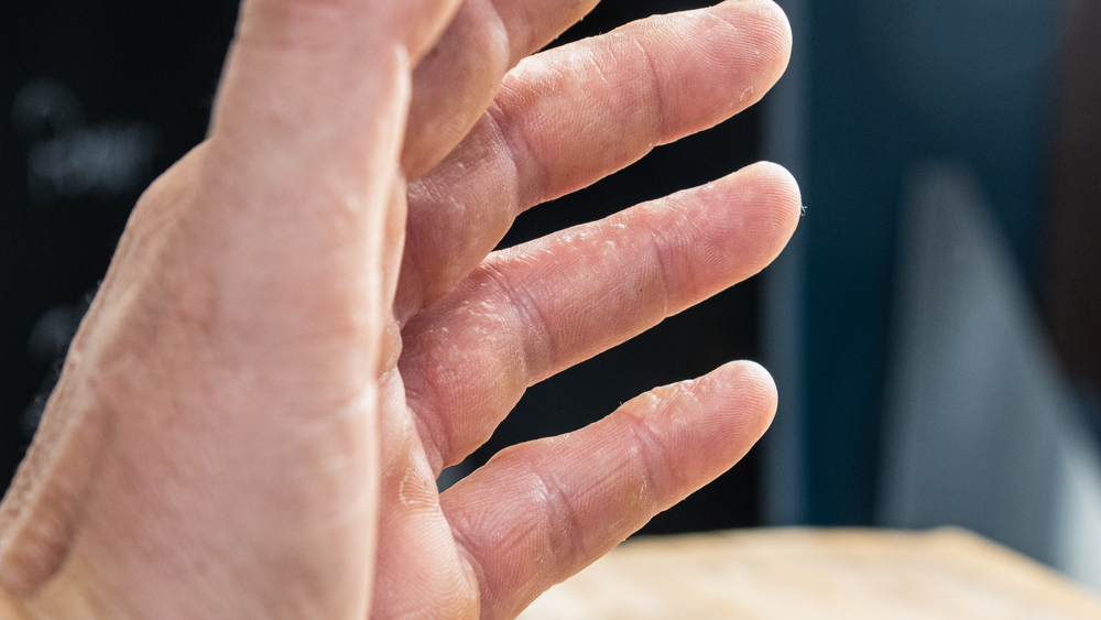 天氣乾冷手就脫皮？揭密手指脫皮8大原因：專家傳授4招日常保養建議