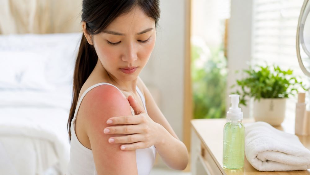 曬傷怎麼辦？皮膚發紅、脫皮先別急著美白，曬傷處理重點曝光