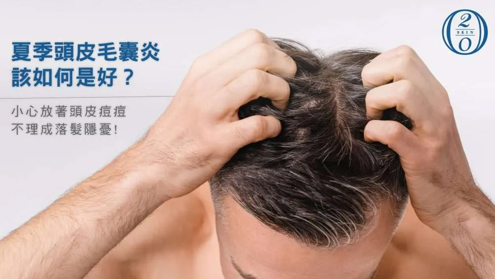夏天頭皮痘痘反覆發作怎麼辦？認識頭皮毛囊炎與頭皮健康管理重點